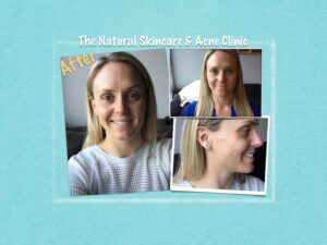 before-and-after-skincare-pics-002